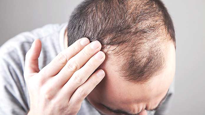 Hair Loss in Women When Should You Worry  Cleveland Clinic